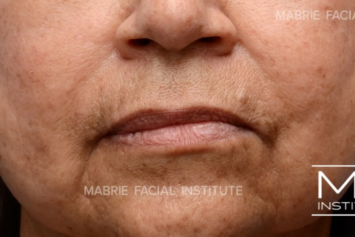 Woman before Subtle Lip Filler treatment