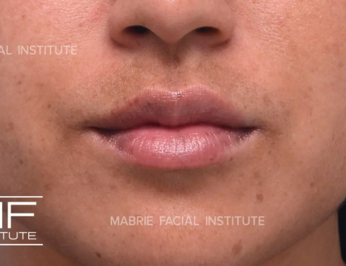 Woman after Subtle Lip Filler treatment