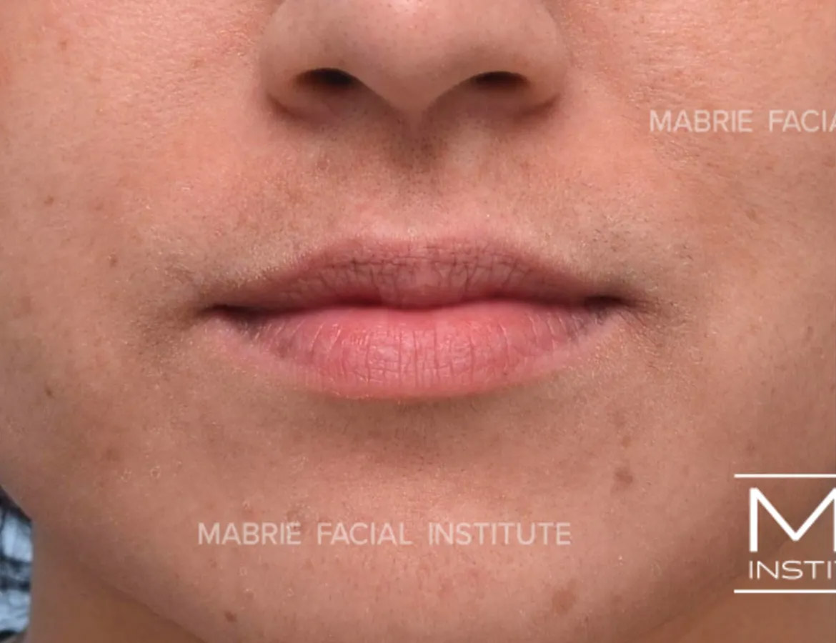 Woman before Subtle Lip Filler treatment