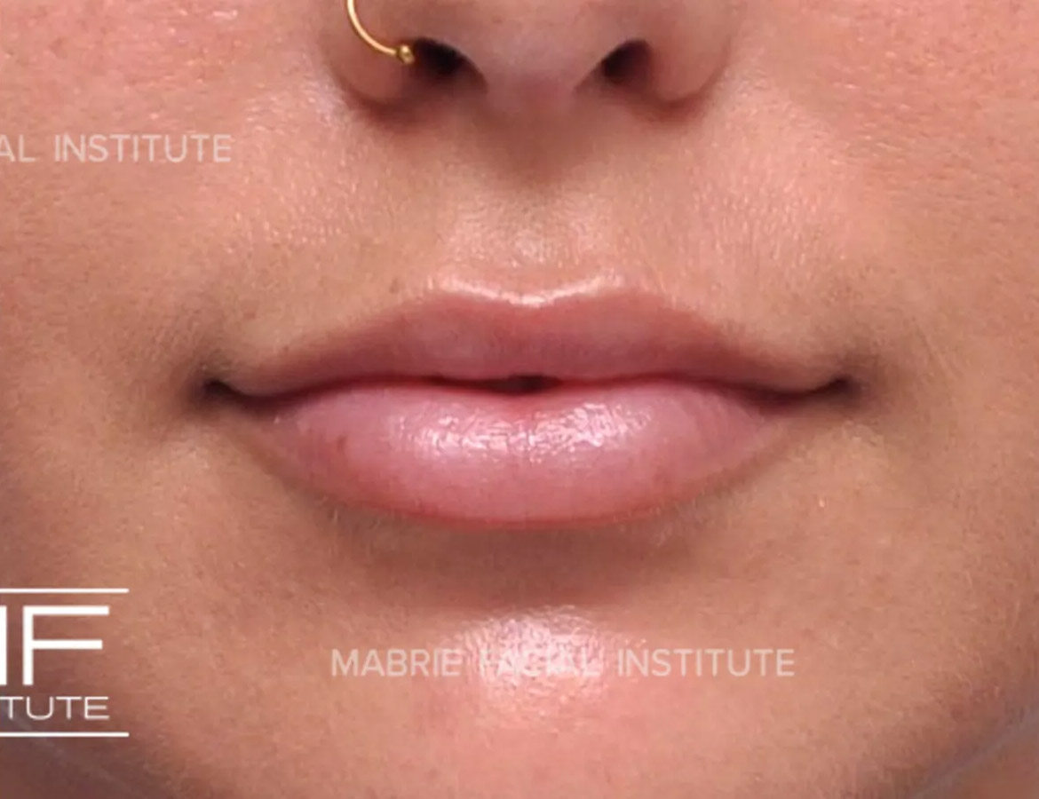 Woman after Subtle Lip Filler treatment