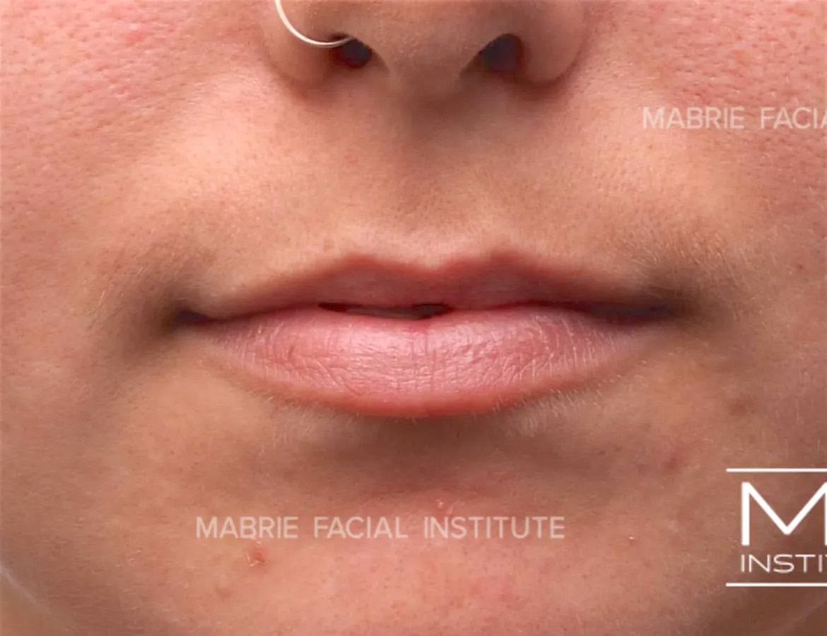 Woman before Subtle Lip Filler treatment