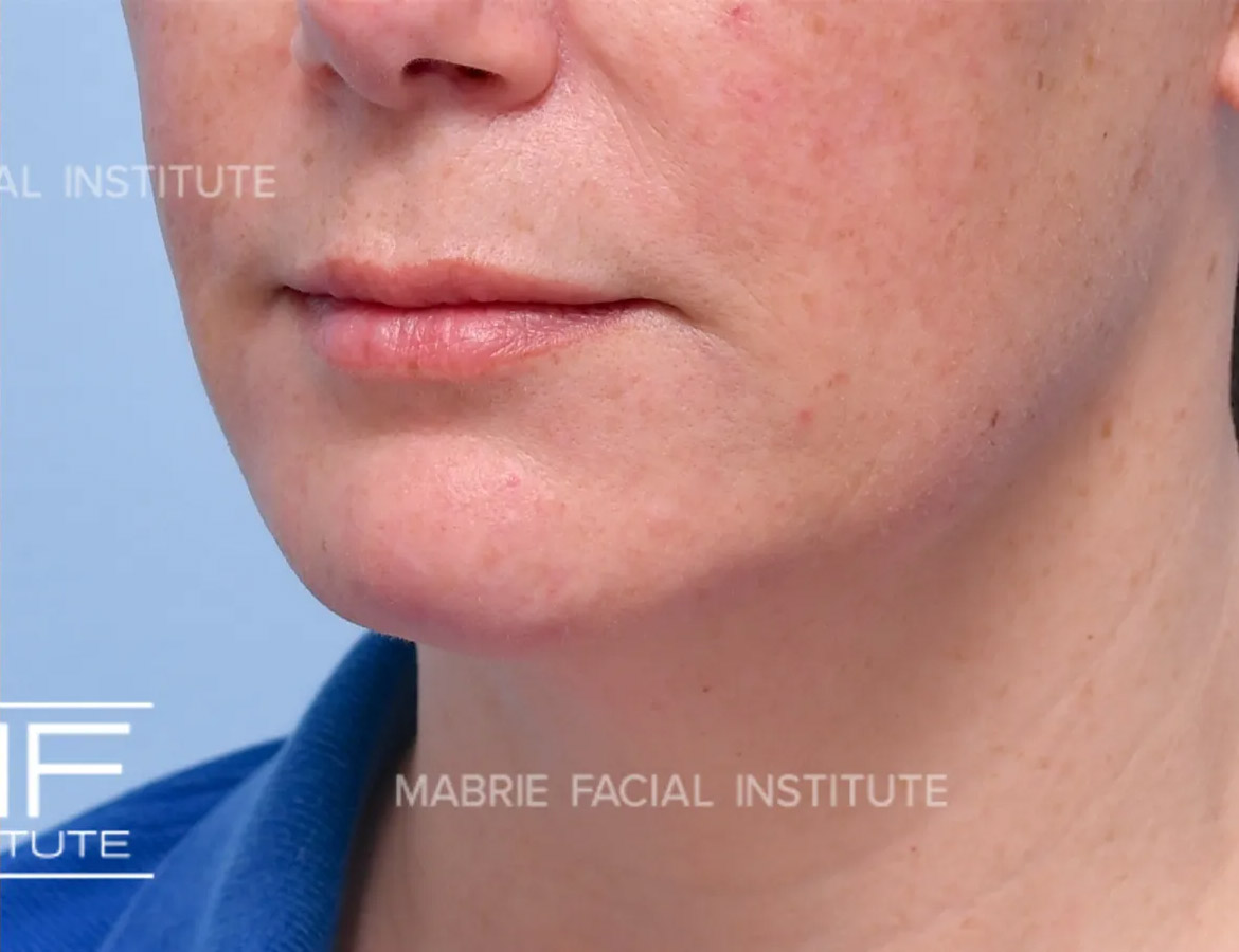 Woman after ​​Complete Lower Face Rejuvenation Filler​ Package treatment