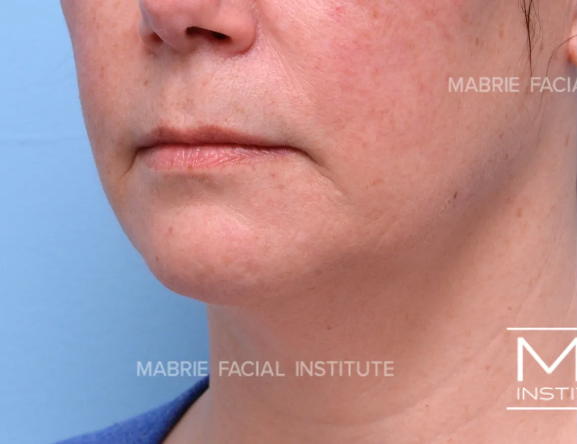 Woman before ​​Complete Lower Face Rejuvenation Filler​ Package treatment