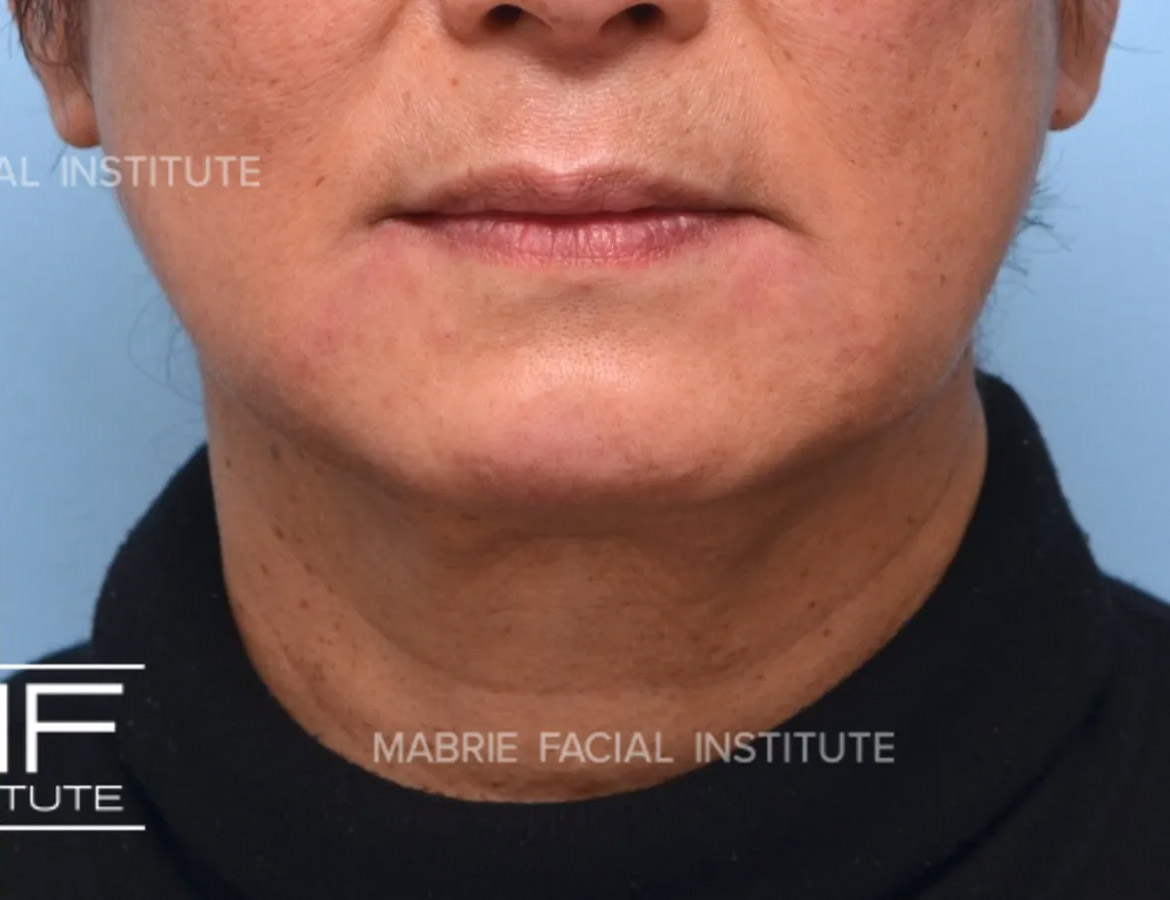 Woman after ​​Complete Lower Face Rejuvenation Filler​ Package treatment
