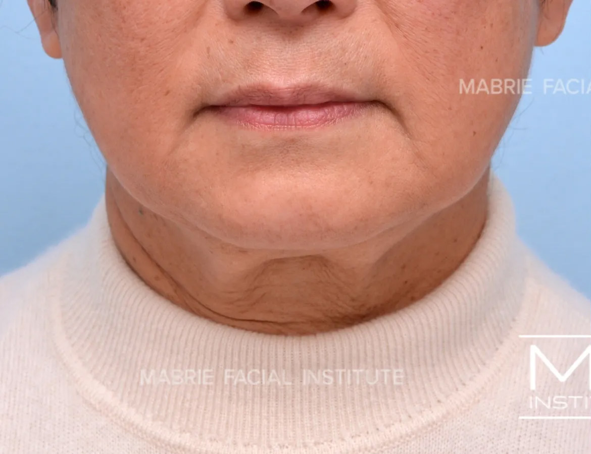 Woman before ​​Complete Lower Face Rejuvenation Filler​ Package treatment