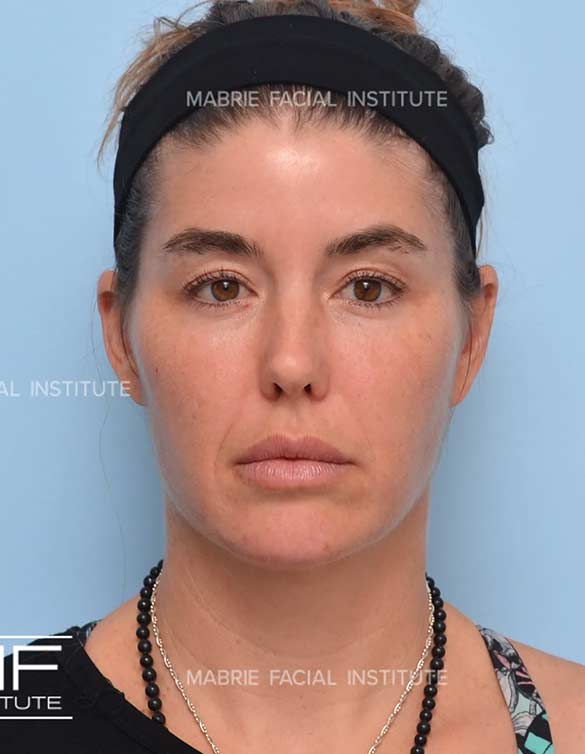 After treatment for under eye bags and dark circles