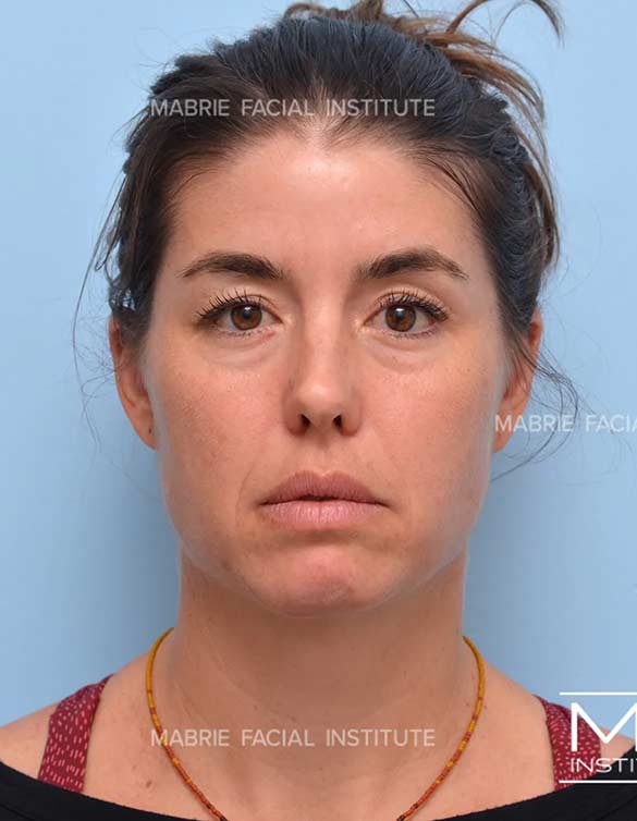 Before treatment for under eye bags and dark circles