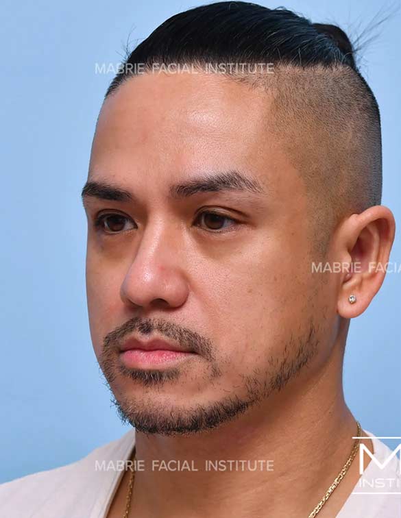 Before treatment for under eye bags and dark circles