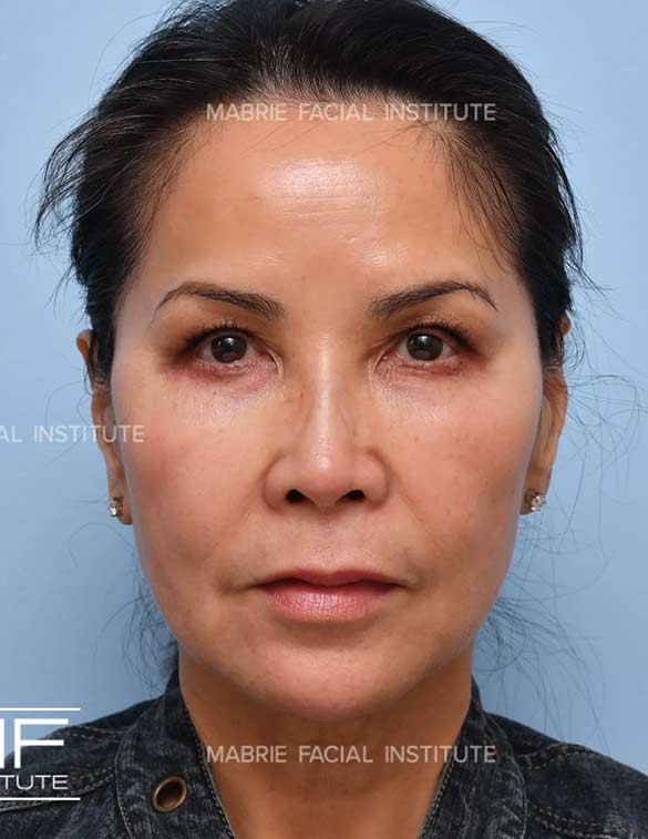 After treatment for under eye bags and dark circles