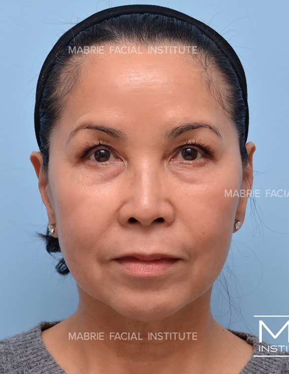 Before treatment for under eye bags and dark circles
