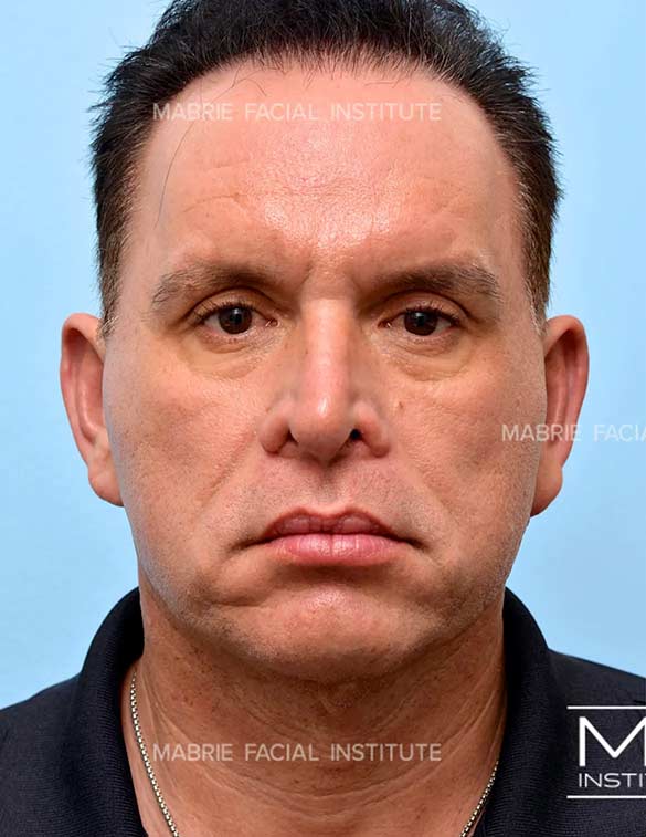 Before treatment for under eye bags and dark circles