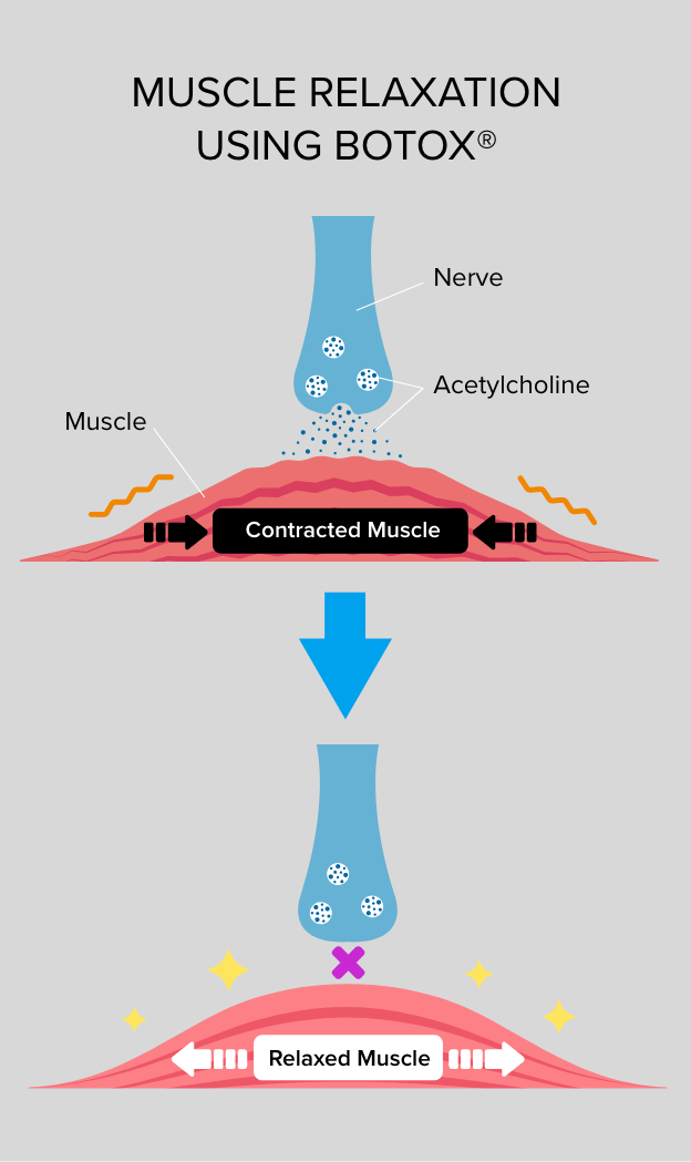 diagram showing muscle relaxation using Botox