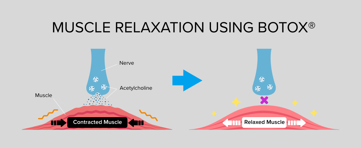 diagram showing muscle relaxation using Botox