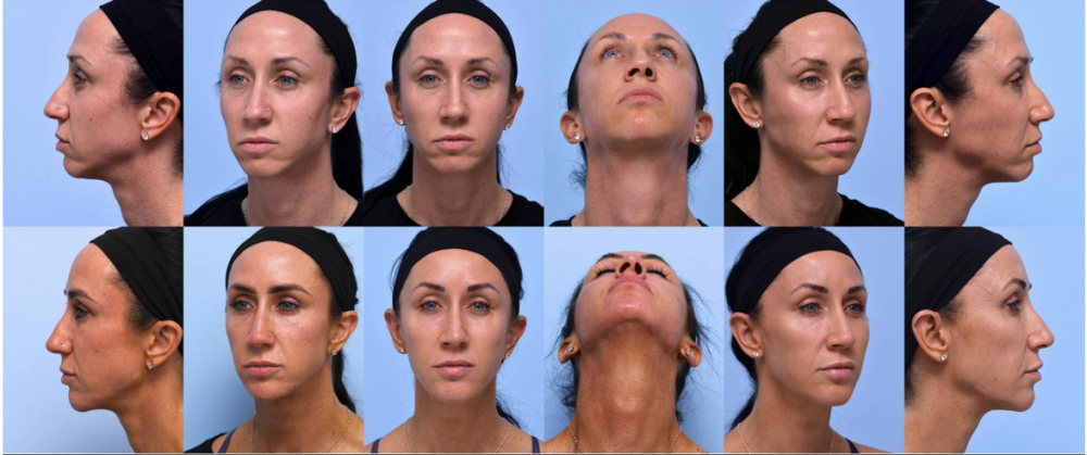 Before and after case #624