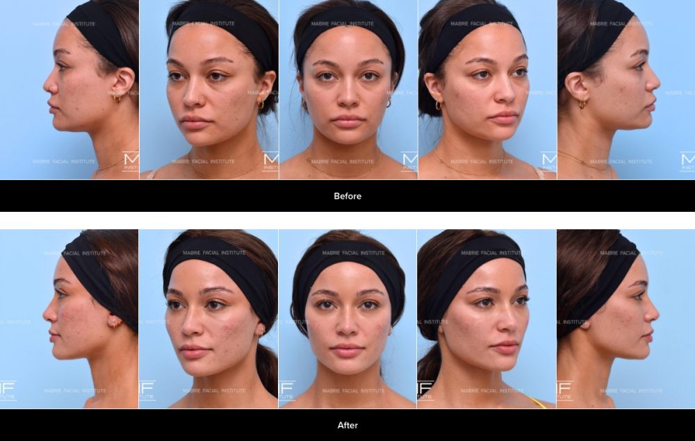 Case 1368 – before and after strips in frontal, three-quarter, and profile views of Mabrie Facial Institute patient. 
