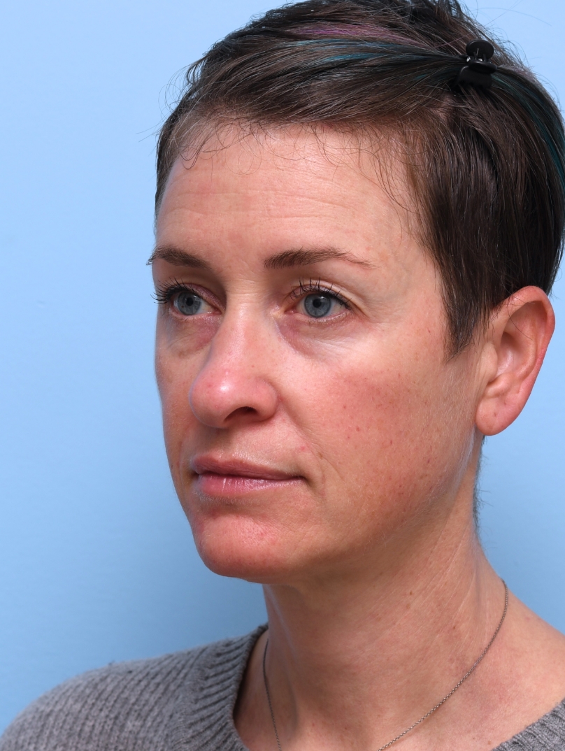 Before: Noticeable volume loss in the cheeks and midface. 