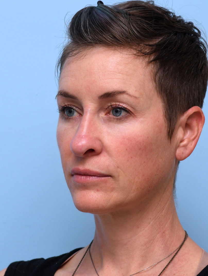 After Midface & Cheek filler: Contours rebuilt; light balanced. 