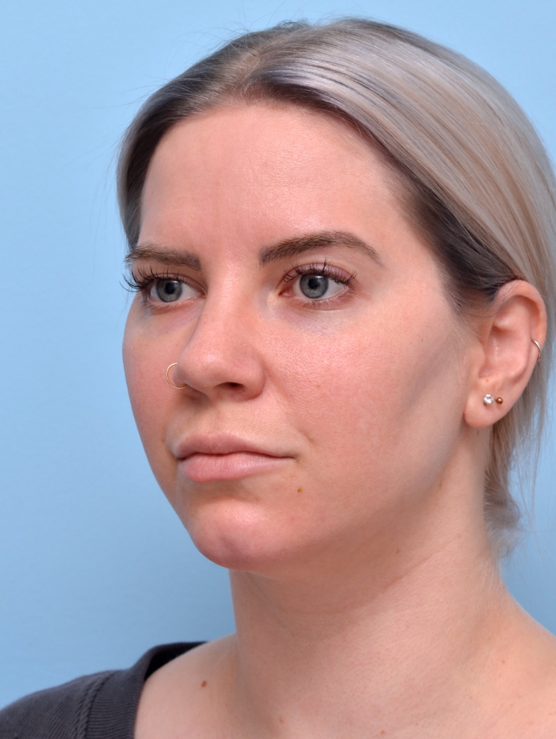 After Jawline Filler: Clean, straight, jawline defined with filler. 