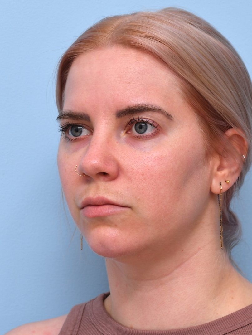 Nearly a Year Later: Jawline is still angular and pronounced with more definition than her baseline. 