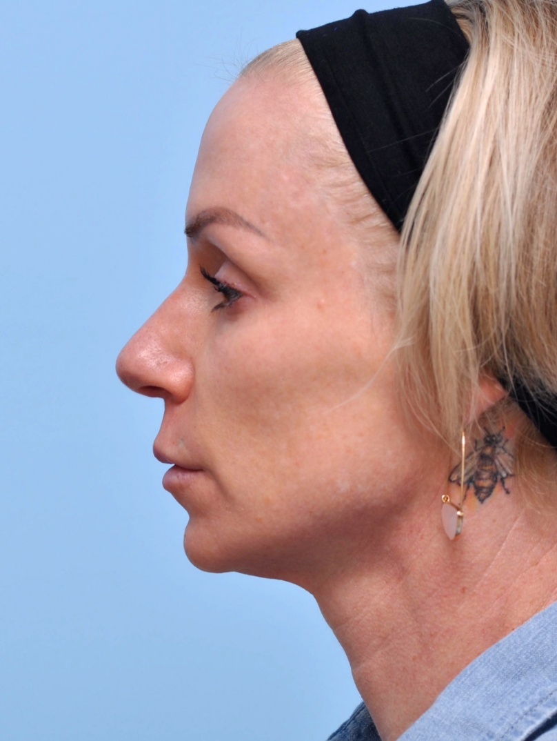 Before: Noticeable lack of definition along chin and jawline.