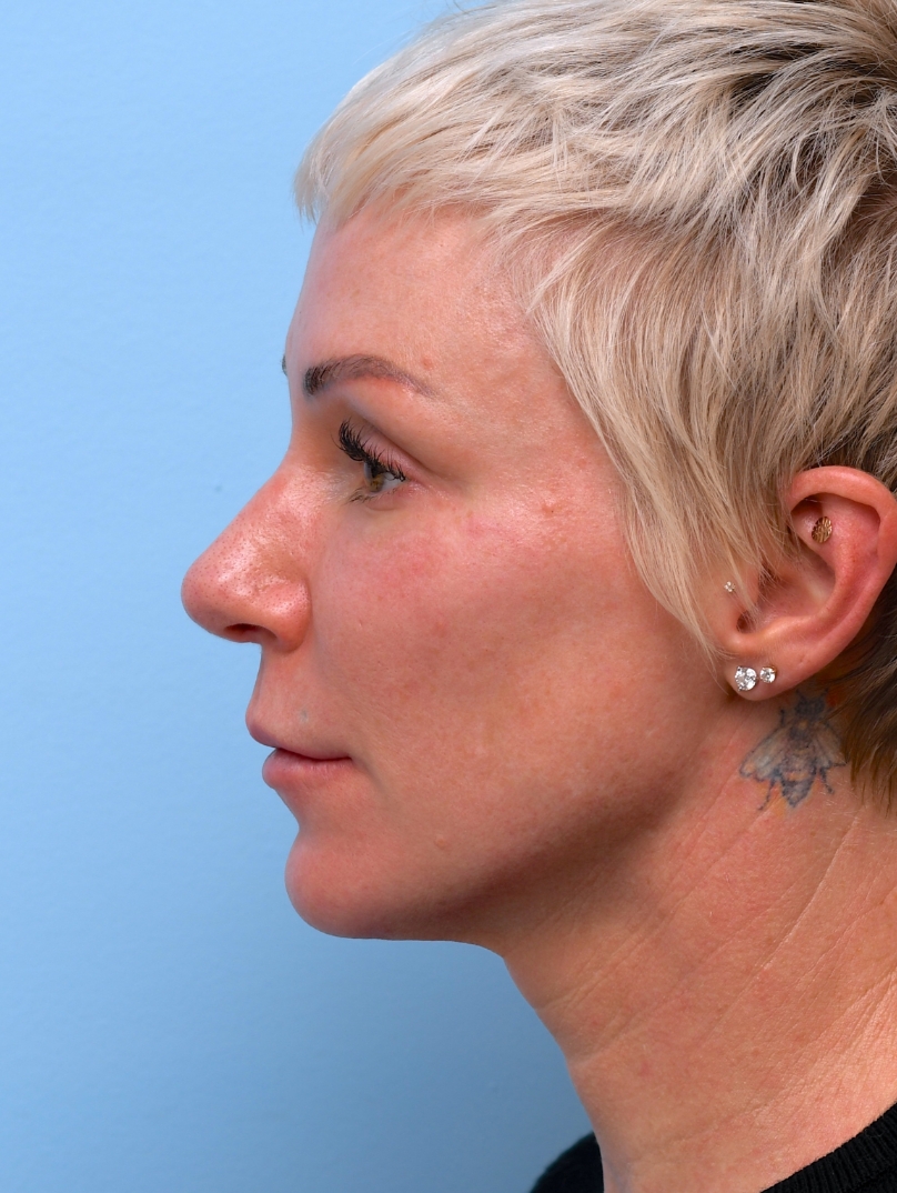 After: Subtle enhancements sharpen definition and profile.