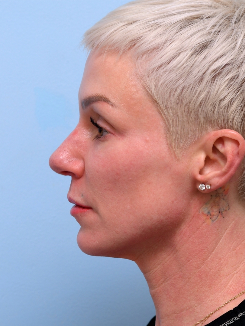 1 Year Later: Still sculpted and youthful, showing the lasting power of chin and jawline filler.