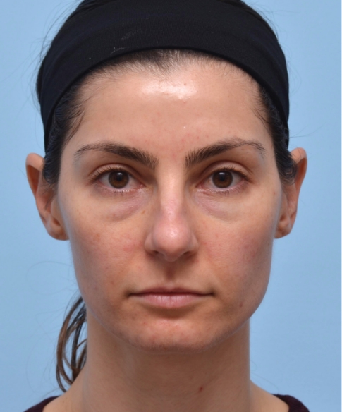 Full Face Before Shadowing under eyes, nose & jowls. 