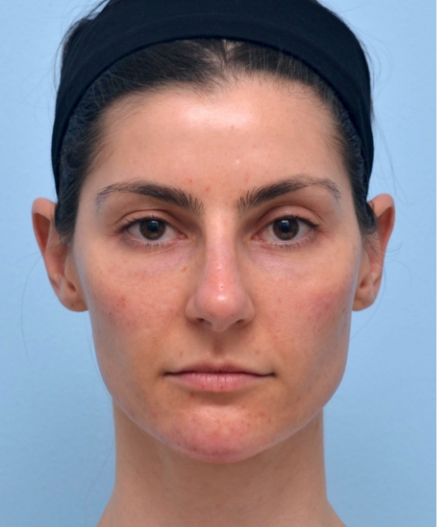 Full Face 1 Month Later Lifted + refreshed; structure restored.