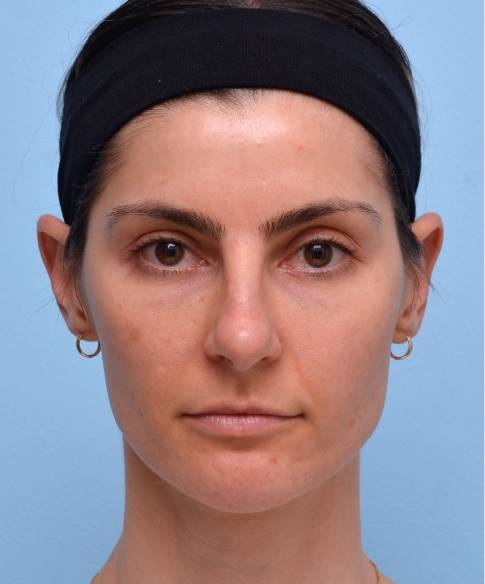 Full Face 2+ Years, No Touch-Ups: Still looking refreshed; ready for small touch-up.