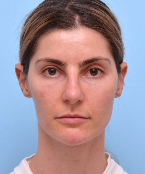 Full Face Almost 4 Years Into Care: Two years untreated — balanced design endures.