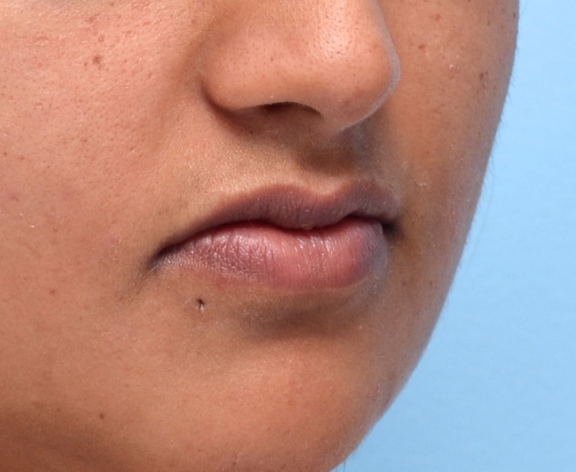 Before: Natural lips, baseline without filler.