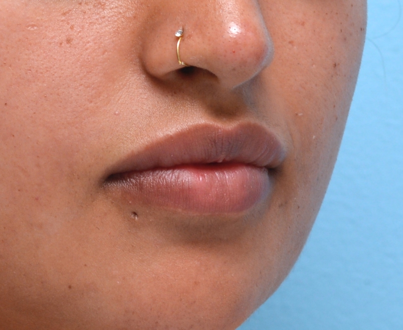 After Treatment: Fuller, balanced shape with subtle enhancement. 