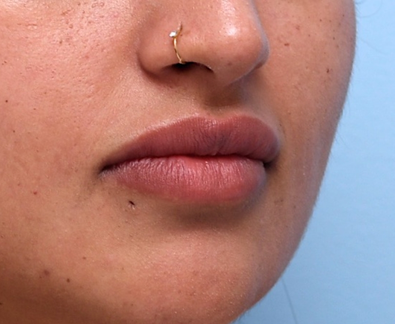 Nearly 2 Years Later: Still soft, defined, and more voluminous than baseline—showing the lasting impact of lip filler with touch-ups.