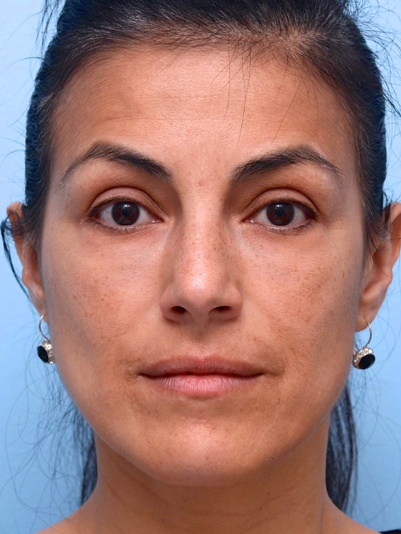 MFI 4 Years After Last Treatment