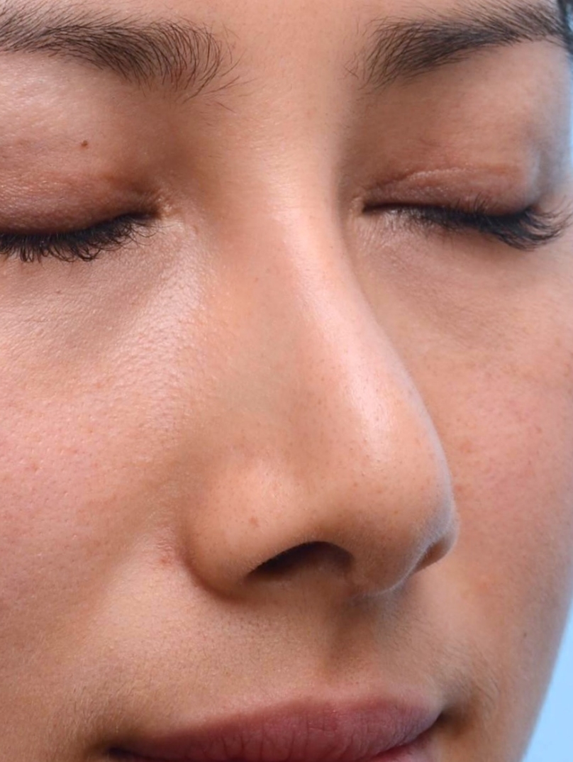 Before: Soft bridge; undefined tip. 