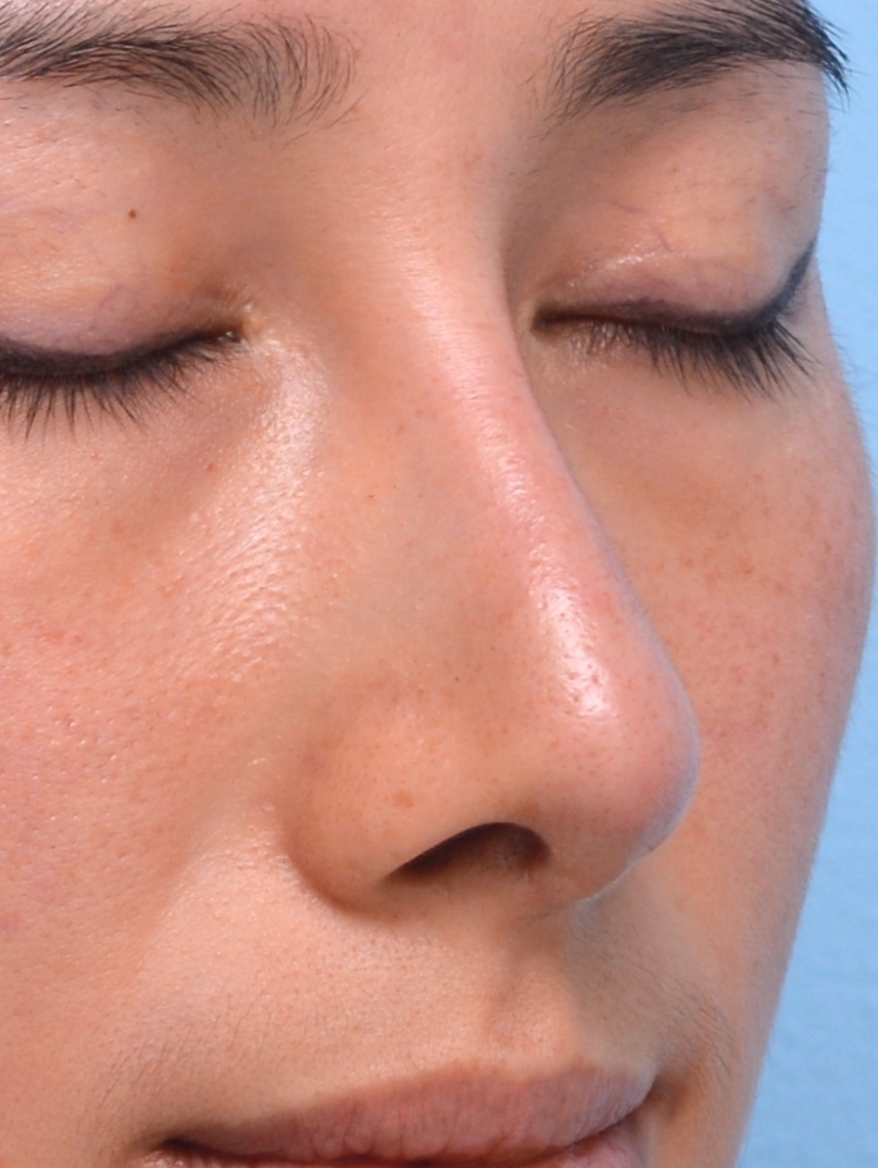 After Treatment: Smooth, symmetrical profile.