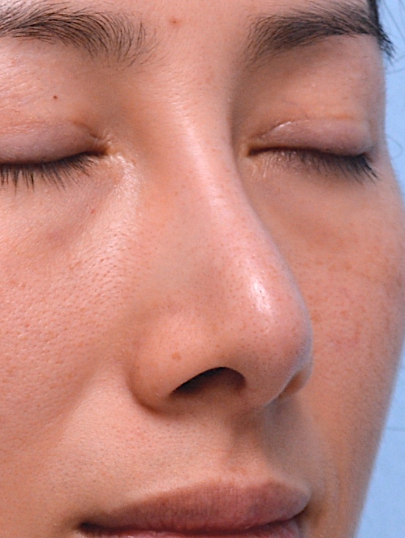 3 years after treatment: Refined shape endures; precision placement shows.