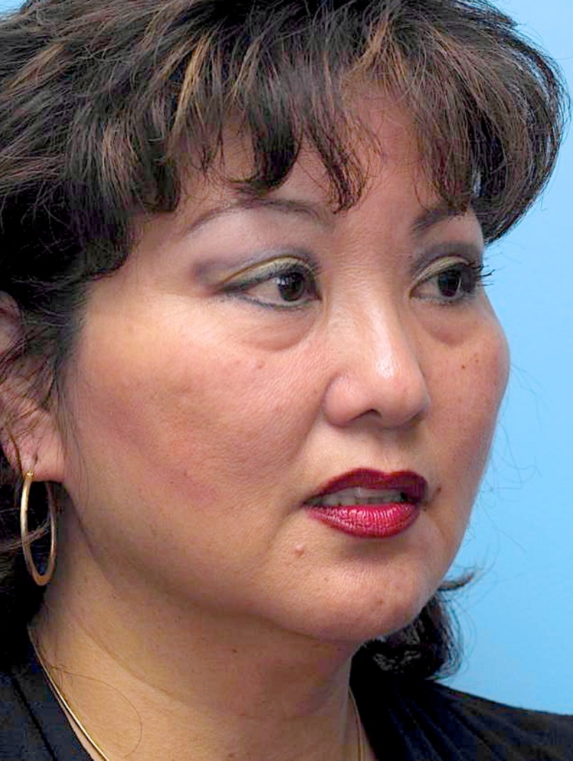 Before: Prominent marionette lines create heaviness around the mouth. 