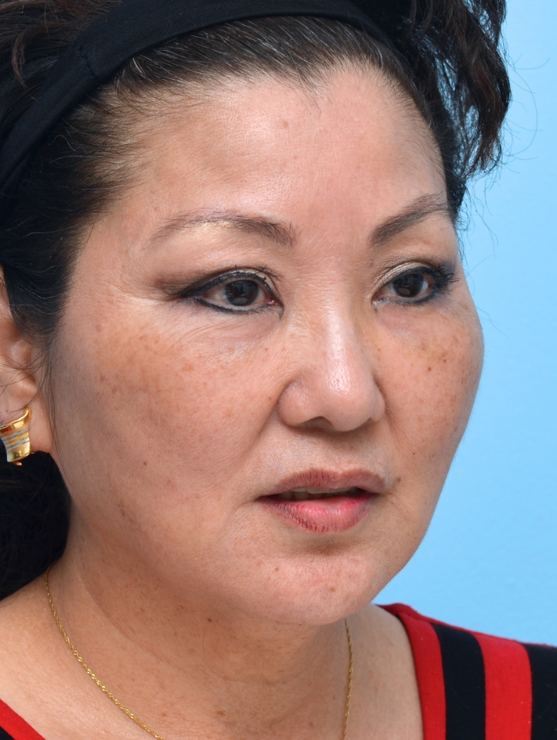 After Treatment: Noticeable softening of the folds, restoring a smoother contour.