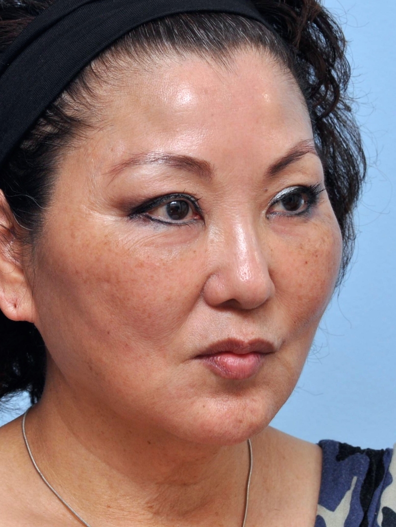 1 Year Later: Results remain defined and natural, with marionette lines still softened.