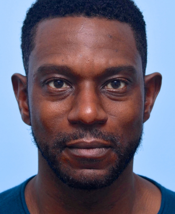 Under Eye Before: Noticeable under-eye hollows and tired appearance. 