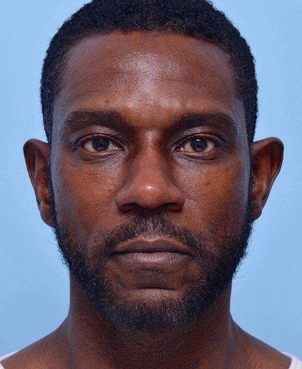 Under Eye 3 Years Later, No Touch-Ups: Still bright and smooth—filler longevity in action. 