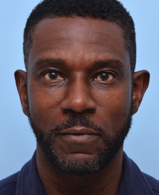 Under Eye 4.5 Years Into Care: A subtle refresh brings brightness back under the eyes. 