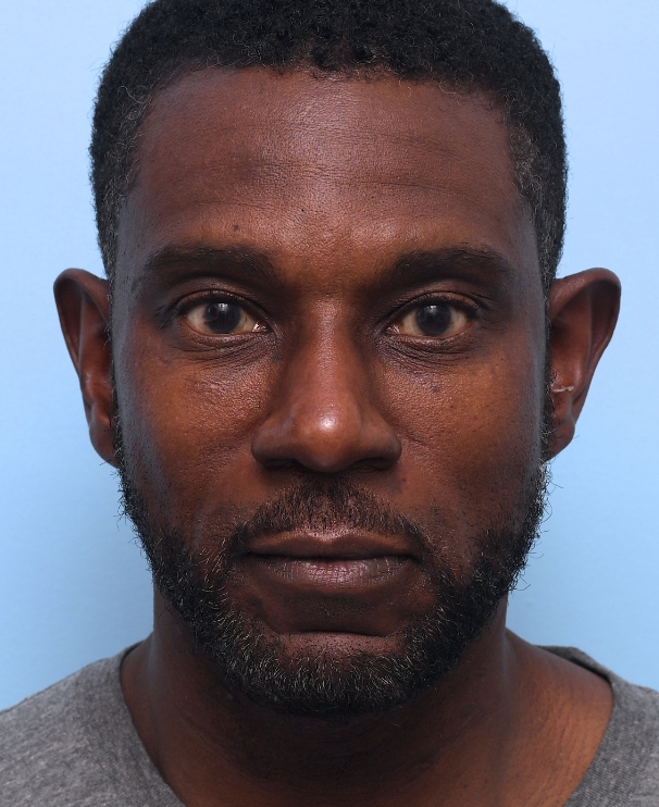 Under Eye After 6 years of Care: Still looking rested and more youthful than his 2019 baseline.