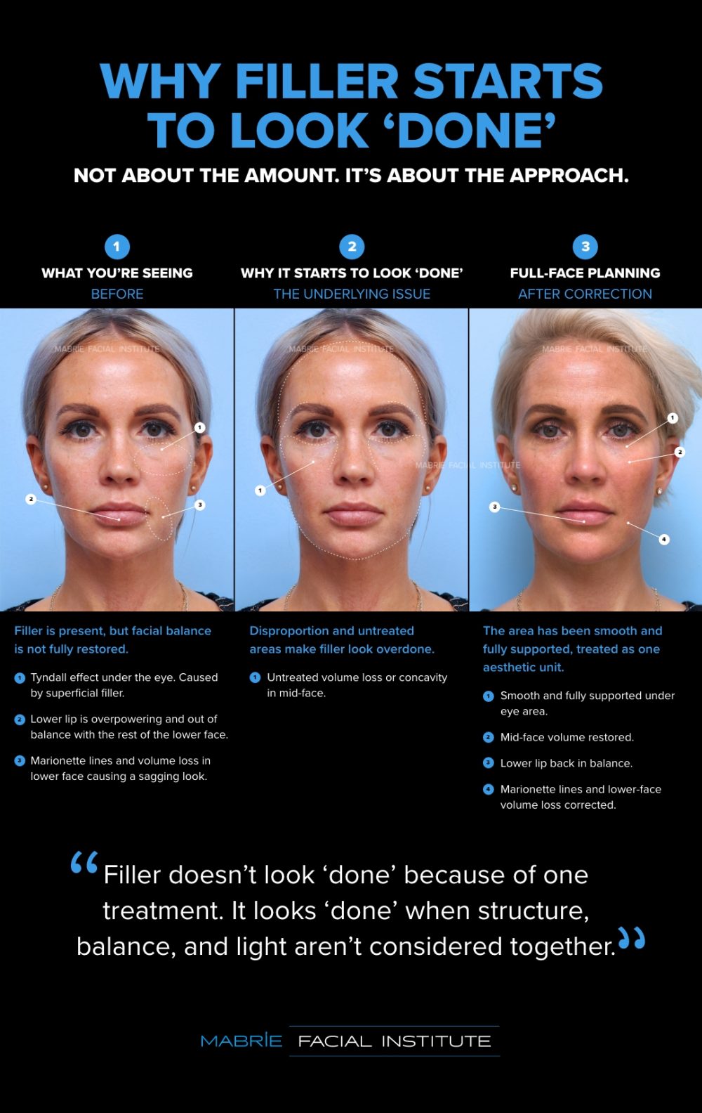Why Filler Starts to Look ‘Done’