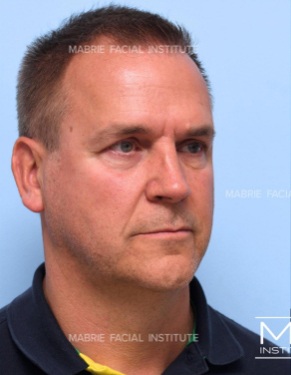 Man before complete facial rejuvenation