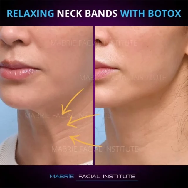 Botox for Neck Bands: A Simple Solution for a Smoother Neckline 💉✨

As we age, the vertical bands in the neck—called platysmal bands—become more prominent, creating a “corded” or sagging appearance. In this case, our patient in her 40s wanted a smoother neckline.

By carefully injecting Botox into these bands, we relax the underlying muscles, softening their appearance. The result? A subtle yet effective improvement! 

What do you think? 

SUMMARY:
💉Treatment (What to ask for): Botox for vertical neck bands
👀How it works: Botox
⏰Time it takes: Procedure itself takes about 10-15 minutes

📱Phone/Text: (415) 445-9513
✉️Email: IG@drmabrie.com 

S
T
A
Y

B
E
A
U
T
I
F
U
L

#neckband #botox #necklines #botoxnfillers #mabriefacialinstitute #sanfrancisco #BayArea