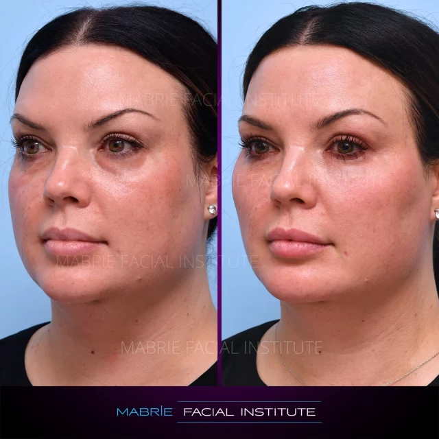 This patient in her 40s was DONE with the tired look! 😴 
She wanted to wave goodbye to dark circles for good, so Dr. Mabrie created a plan to bring back her glow and address her concerns.

After some under-eye filler and a subtle cheekbone lift, she’s looking refreshed, radiant, and ready to take on the world! ✨

Stay tuned for more stunning transformations like this one! ⬆️
What’s your favorite filler treatment? 👀

SUMMARY:
💉Treatment (What to ask for): Under Eye Fillers
👀How it works: Dermal Fillers Injections 
🎉Results: Filler treatment achieved in 2-3 visits on average
⏰Time it takes: Procedure itself takes about 30 minutes
📆Recovery: Allow for slight swelling, tenderness, bruising. Subsides usually after 2-10 days.
⏲️How long does it last? Fillers can last several years, gradually decreasing over time. To maintain optimal results, a touch-up is typically recommended once a year
📱Phone/Text: (415) 445-9513
✉️Email: IG@drmabrie.com 

S
T
A
Y

B
E
A
U
T
I
F
U
L

#sanfrancisco #botoxnfillers #mabriefacialinstitute #fillers #undereyefiller #darkcircles #undereyeshadows #undereyebags #fillerbeforeandafters #BayArea