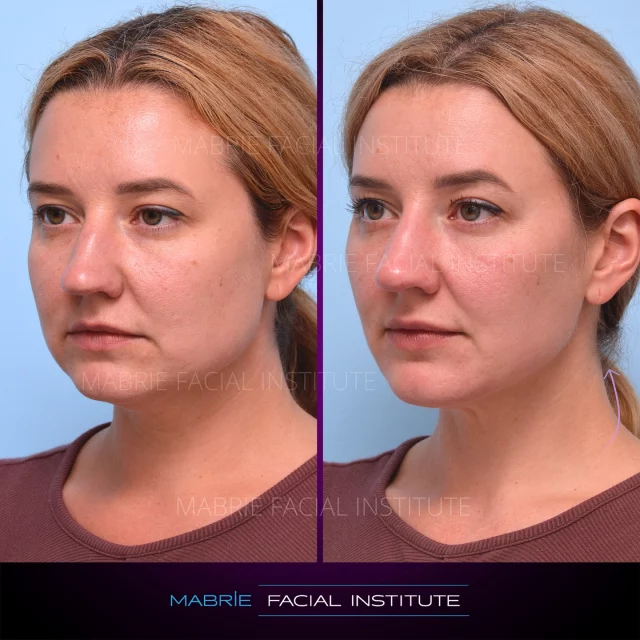 Mom of 2. - Finally her turn. 

After two kids and months of crushing it with clean eating and workouts, she felt ready to address what bothered her—the shape of her lower face. She grinds her teeth at night, which was widening her jaw and adding tension. She also hoped for a subtle nose tweak—without surgery.✨

In just 10 weeks, we were able to achieve her goals—enough time for masseter Botox to take full effect and for filler to settle into a natural, balanced result.

She’s glowing, confident, and didn’t need a single stitch. 💁‍♀️
➡️ Curious what we treated? Head to the last slide for the full breakdown.

What’s your beauty routine?

SUMMARY:
💉Treatment (What to ask for): Botox and Filler for the Round Face
👀How it works: Dermal Filler and Botox Injections 
🎉Results: Filler treatment achieved in 2-3 visits on average
⏰Time it takes: Procedure itself takes about 30 minutes
📆Recovery: Allow for slight swelling, tenderness, bruising. Subsides usually after 2-10 days.
⏲️How long does it last? Fillers can last several years, gradually decreasing over time. To maintain optimal results, a touch-up is typically recommended once a year
📱Phone/Text: (415) 445-9513
✉️Email: IG@drmabrie.com 

S
T
A
Y

B
E
A
U
T
I
F
U
L

#FacialBalancing #GlowUpGoals #MasseterBotox #NonSurgicalRhinoplasty #10WeekTransformation #PostBabyRefresh #BeforeAndAfter #MabrieMagic