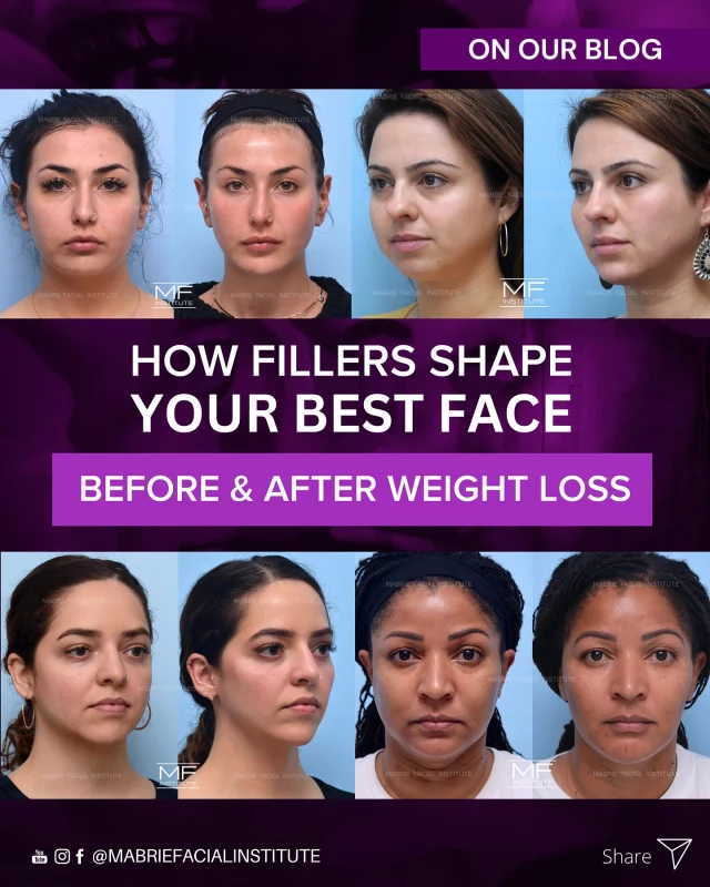 Losing weight and noticing changes in the face? 😕💉

Weight loss can lead to facial volume loss, causing hollow cheeks, prominent tear troughs, deep nasolabial folds, and sunken temples—often called “Ozempic Face.” 

In our latest blog, we cover:
🔹 Understanding Facial Volume Loss After Weight Loss
🔹 What Is Ozempic Face?
🔹 What Causes Ozempic Face?
🔹 The Rejuvenating Power of Dermal Fillers
🔹 Do You Need to Be at Your Goal Weight for Fillers?
🔹 Can Fillers Prevent Sagging During Weight Loss?

Want to learn more? 
Let us know if you’d like the direct link. 👇
https://www.yourfaceinourhands.com/blog/how-fillers-shape-your-best-face-before-and-after-weight-loss/

S
T
A
Y

B
E
A
U
T
I
F
U
L

#MFIblog #fillersSF #fillersSanFrancisco #weightloss #fillersandweightloss #ozempic #hollowcheeks #nasolabialfolds #teartroughs #mabriefacialinstitute #sanfrancisco